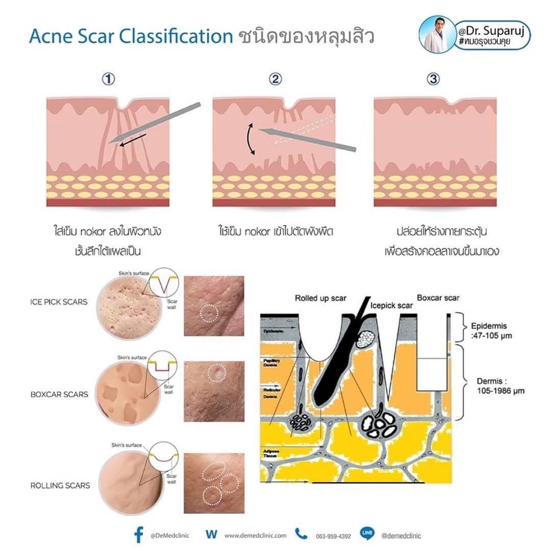 Picosecond Laser ช่วยดูแลหลุมสิวดีขึ้นต่อเนื่องถึงเดือนที่ 9 หลังการรักษาครั้งสุดท้าย