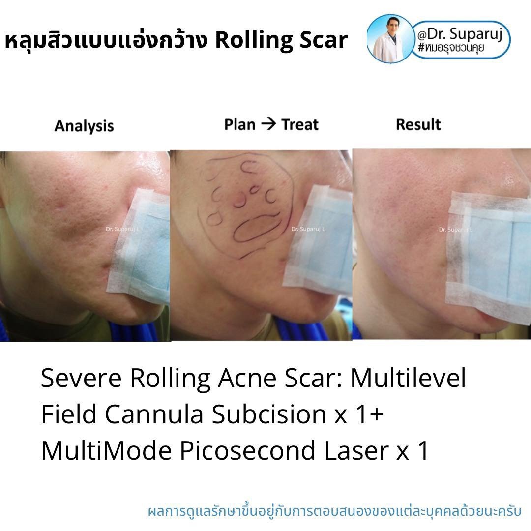 Picosecond Laser ช่วยดูแลหลุมสิวดีขึ้นต่อเนื่องถึงเดือนที่ 9 หลังการรักษาครั้งสุดท้าย Picosecond Laser ช่วยดูแลหลุมสิวดีขึ้นต่อเนื่องถึงเดือนที่ 9 หลังการรักษาครั้งสุดท้าย
