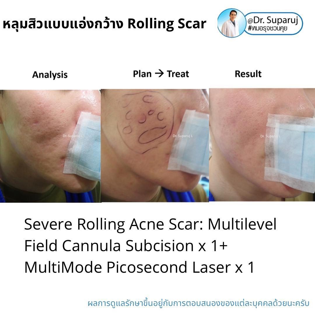 Picosecond Laser ช่วยดูแลหลุมสิวดีขึ้นต่อเนื่องถึงเดือนที่ 9 หลังการรักษาครั้งสุดท้าย