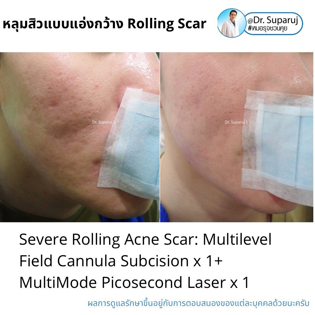 Picosecond Laser ช่วยดูแลหลุมสิวดีขึ้นต่อเนื่องถึงเดือนที่ 9 หลังการรักษาครั้งสุดท้าย Picosecond Laser ช่วยดูแลหลุมสิวดีขึ้นต่อเนื่องถึงเดือนที่ 9 หลังการรักษาครั้งสุดท้าย