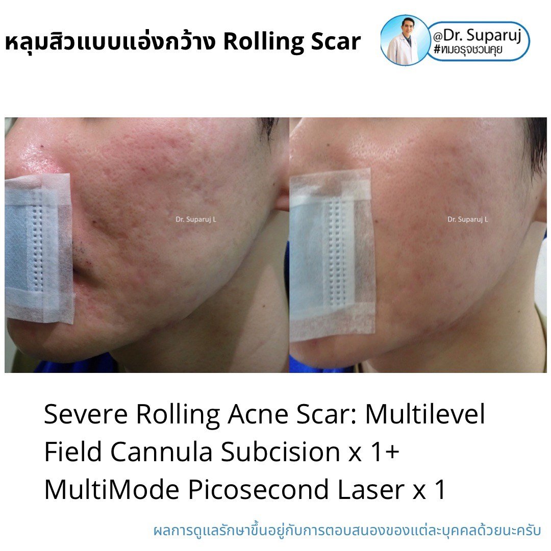 Picosecond Laser ช่วยดูแลหลุมสิวดีขึ้นต่อเนื่องถึงเดือนที่ 9 หลังการรักษาครั้งสุดท้าย Picosecond Laser ช่วยดูแลหลุมสิวดีขึ้นต่อเนื่องถึงเดือนที่ 9 หลังการรักษาครั้งสุดท้าย