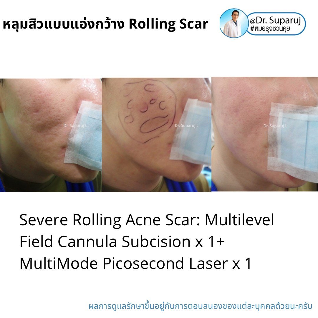 Picosecond Laser ช่วยดูแลหลุมสิวดีขึ้นต่อเนื่องถึงเดือนที่ 9 หลังการรักษาครั้งสุดท้าย Picosecond Laser ช่วยดูแลหลุมสิวดีขึ้นต่อเนื่องถึงเดือนที่ 9 หลังการรักษาครั้งสุดท้าย