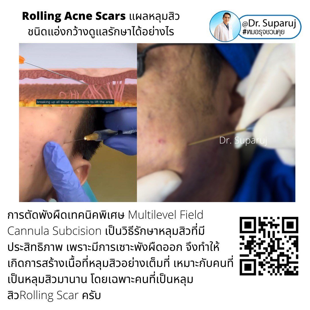 Picosecond Laser ช่วยดูแลหลุมสิวดีขึ้นต่อเนื่องถึงเดือนที่ 9 หลังการรักษาครั้งสุดท้าย Picosecond Laser ช่วยดูแลหลุมสิวดีขึ้นต่อเนื่องถึงเดือนที่ 9 หลังการรักษาครั้งสุดท้าย