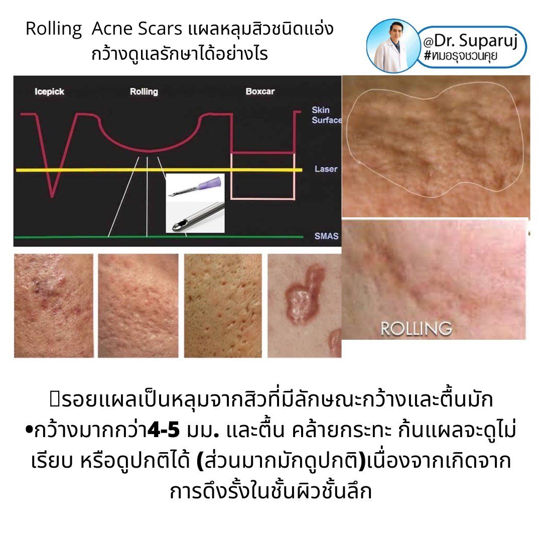 Picosecond Laser ช่วยดูแลหลุมสิวดีขึ้นต่อเนื่องถึงเดือนที่ 9 หลังการรักษาครั้งสุดท้าย Picosecond Laser ช่วยดูแลหลุมสิวดีขึ้นต่อเนื่องถึงเดือนที่ 9 หลังการรักษาครั้งสุดท้าย