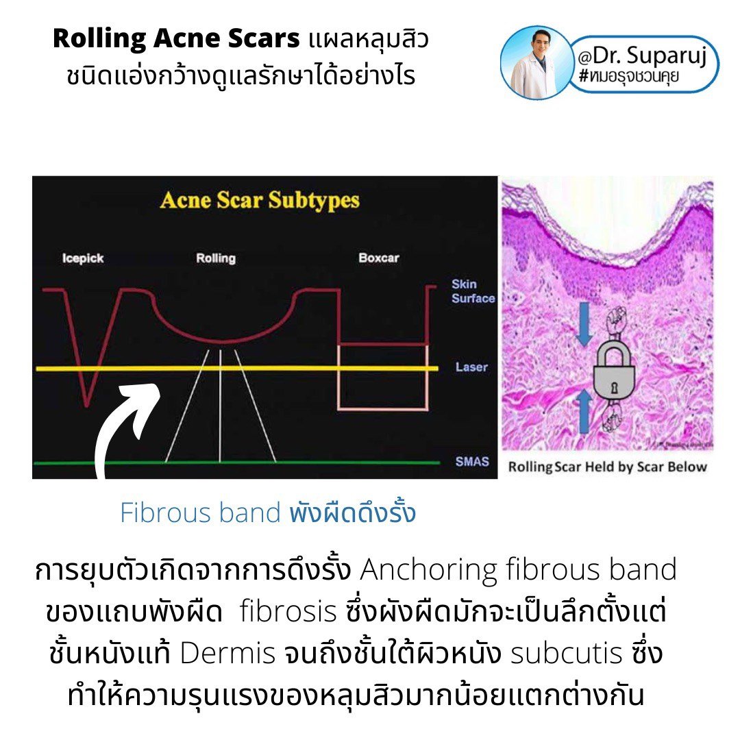 Picosecond Laser ช่วยดูแลหลุมสิวดีขึ้นต่อเนื่องถึงเดือนที่ 9 หลังการรักษาครั้งสุดท้าย Picosecond Laser ช่วยดูแลหลุมสิวดีขึ้นต่อเนื่องถึงเดือนที่ 9 หลังการรักษาครั้งสุดท้าย