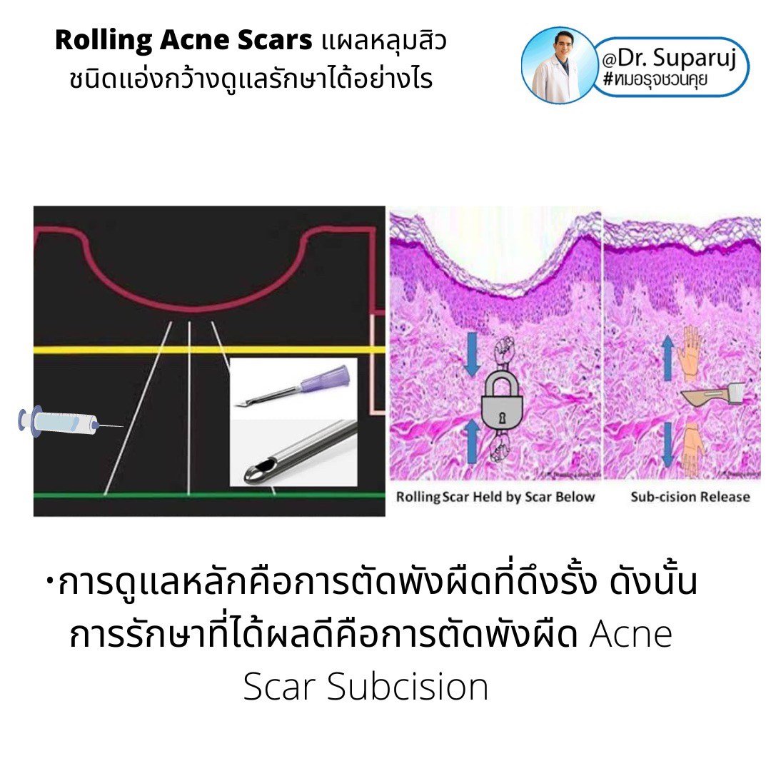 Picosecond Laser ช่วยดูแลหลุมสิวดีขึ้นต่อเนื่องถึงเดือนที่ 9 หลังการรักษาครั้งสุดท้าย Picosecond Laser ช่วยดูแลหลุมสิวดีขึ้นต่อเนื่องถึงเดือนที่ 9 หลังการรักษาครั้งสุดท้าย