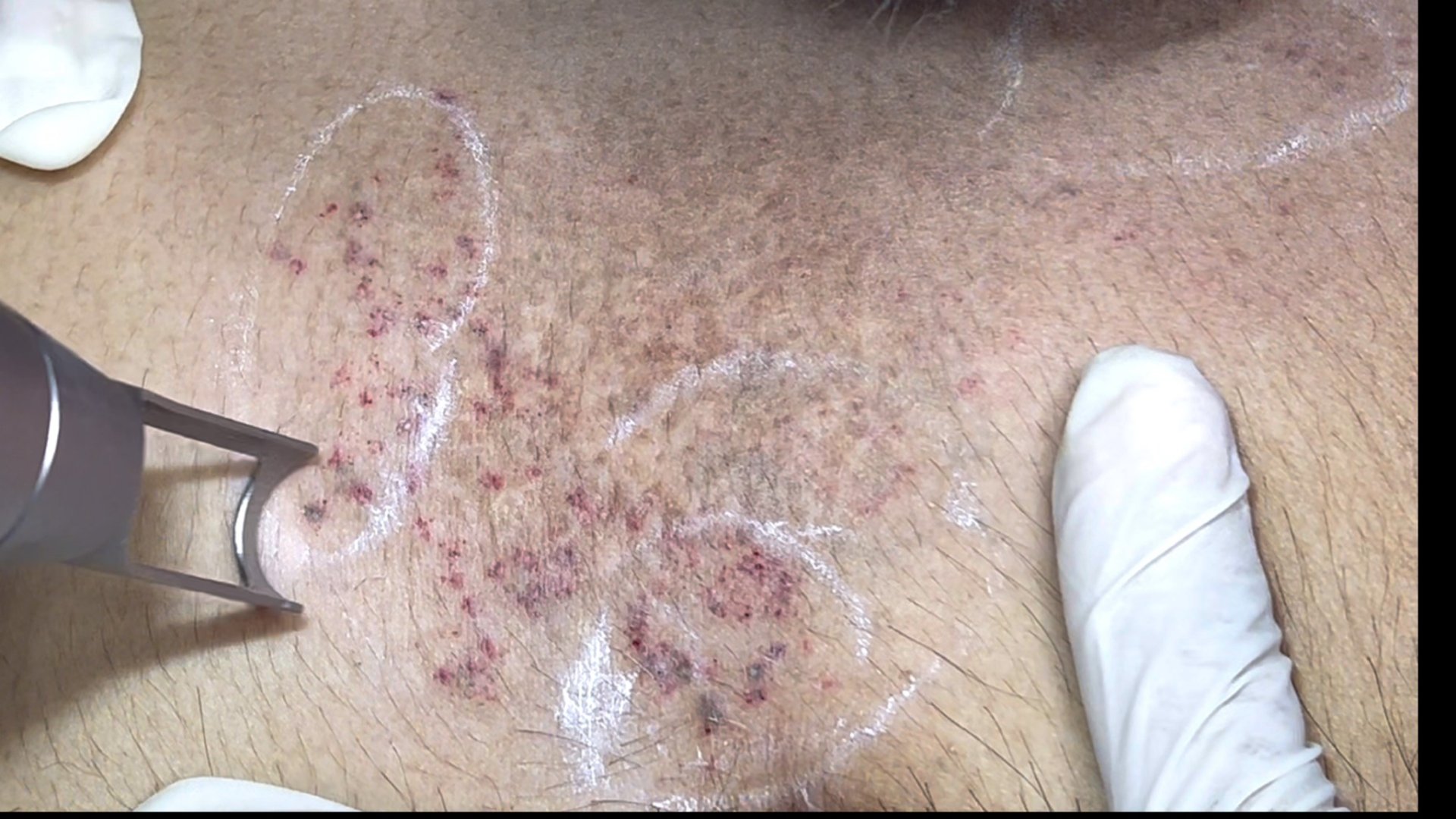 รอยสักจากอุบัติเหตุ (Traumatic Tattoos) มีลักษณะอย่างไร & ดูแลอย่างไร? รอยสักจากอุบัติเหตุ (Traumatic Tattoos) มีลักษณะอย่างไร & ดูแลอย่างไร?