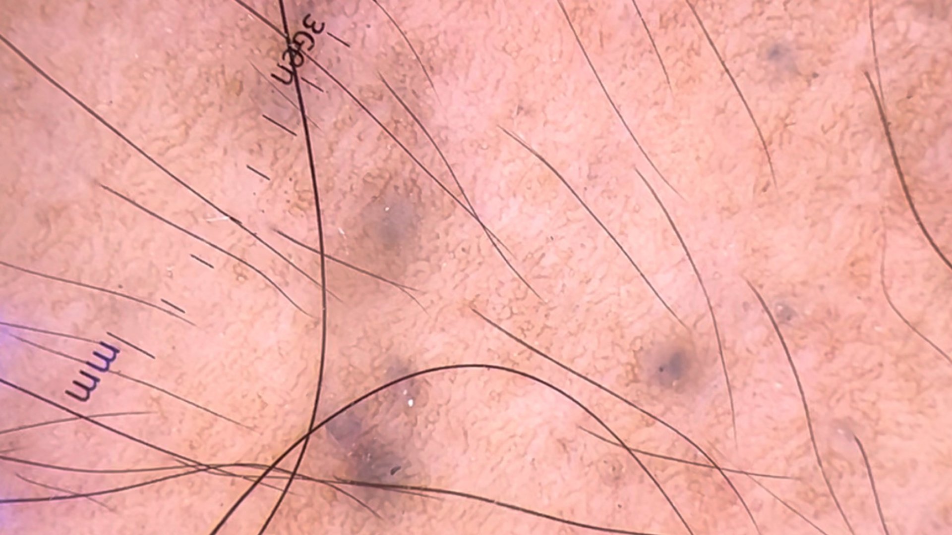 รอยสักจากอุบัติเหตุ (Traumatic Tattoos) มีลักษณะอย่างไร & ดูแลอย่างไร? รอยสักจากอุบัติเหตุ (Traumatic Tattoos) มีลักษณะอย่างไร & ดูแลอย่างไร?