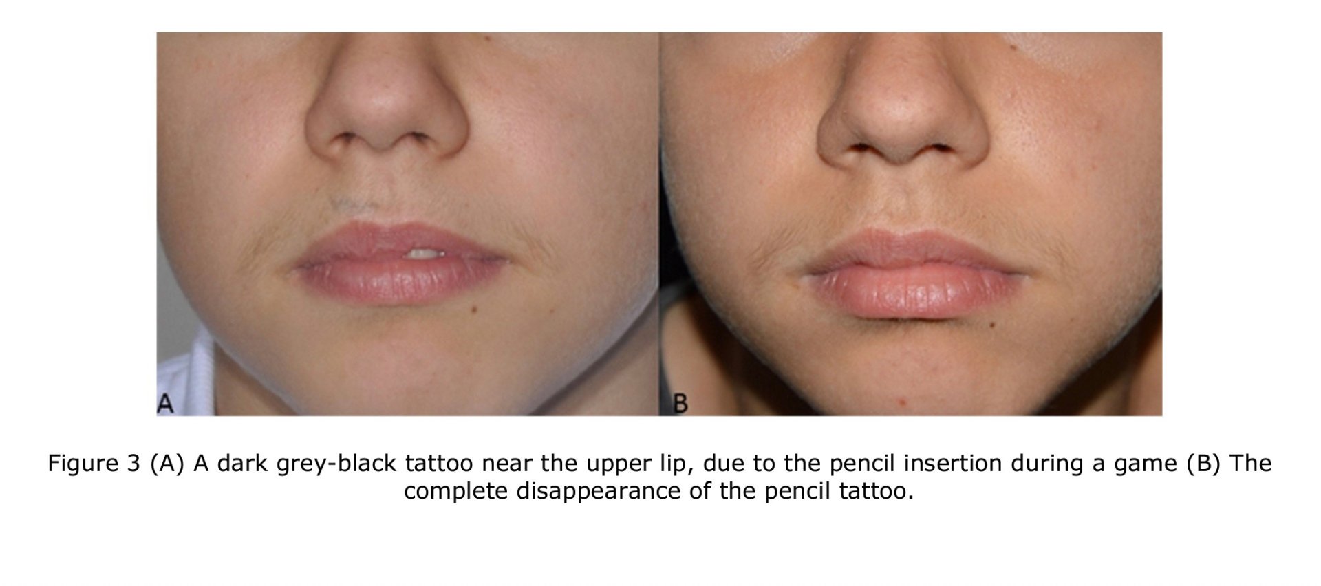 รอยสักจากอุบัติเหตุ (Traumatic Tattoos) มีลักษณะอย่างไร & ดูแลอย่างไร? รอยสักจากอุบัติเหตุ (Traumatic Tattoos) มีลักษณะอย่างไร & ดูแลอย่างไร?