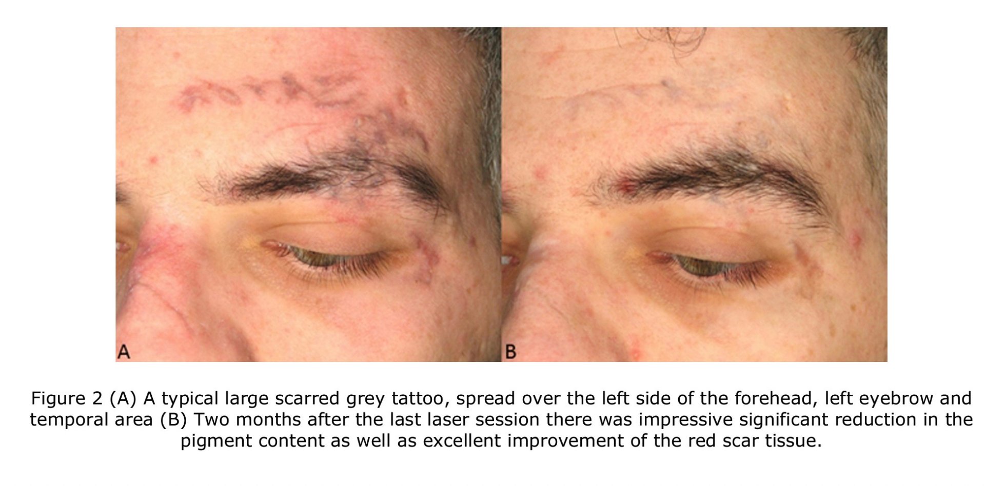 รอยสักจากอุบัติเหตุ (Traumatic Tattoos) มีลักษณะอย่างไร & ดูแลอย่างไร? รอยสักจากอุบัติเหตุ (Traumatic Tattoos) มีลักษณะอย่างไร & ดูแลอย่างไร?