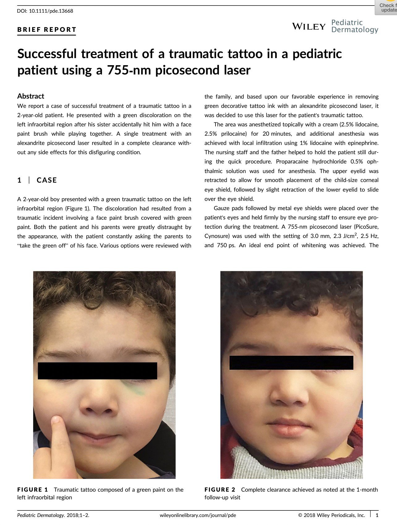 รอยสักจากอุบัติเหตุ (Traumatic Tattoos) มีลักษณะอย่างไร & ดูแลอย่างไร? รอยสักจากอุบัติเหตุ (Traumatic Tattoos) มีลักษณะอย่างไร & ดูแลอย่างไร?