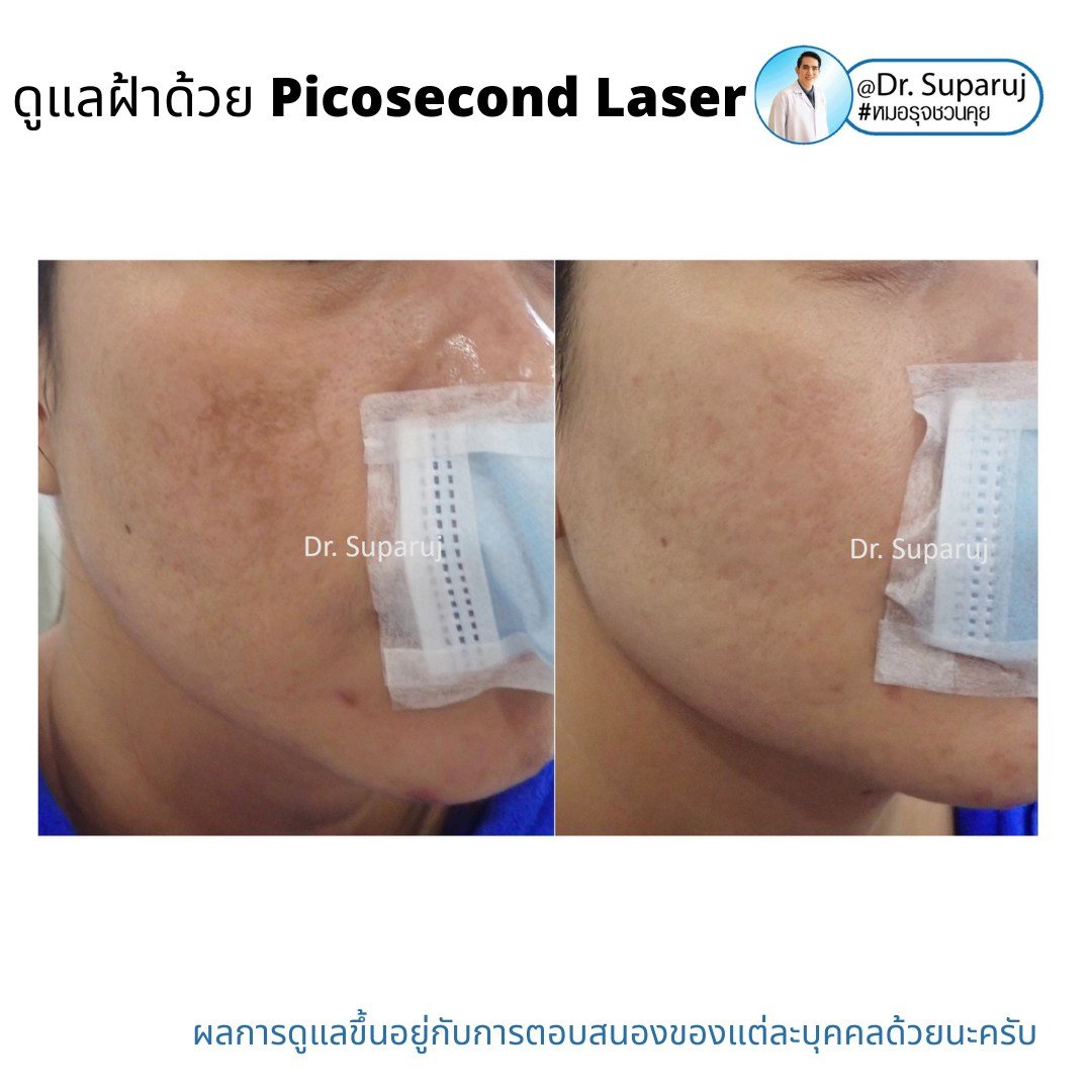 เทคนิคดูแลฝ้าด้วย Picosecond Laser เทคนิคดูแลฝ้าด้วย Picosecond Laser