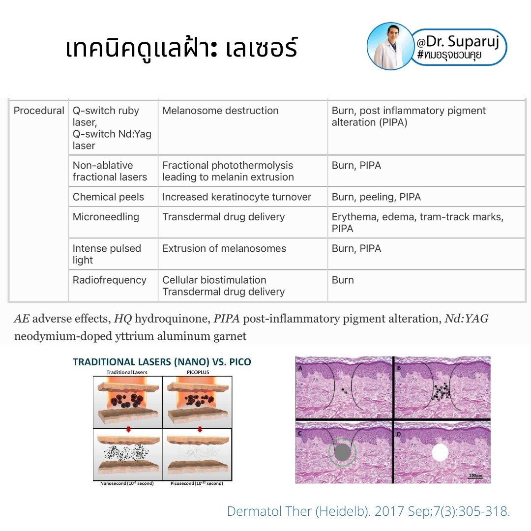 เทคนิคดูแลฝ้าด้วย Picosecond Laser