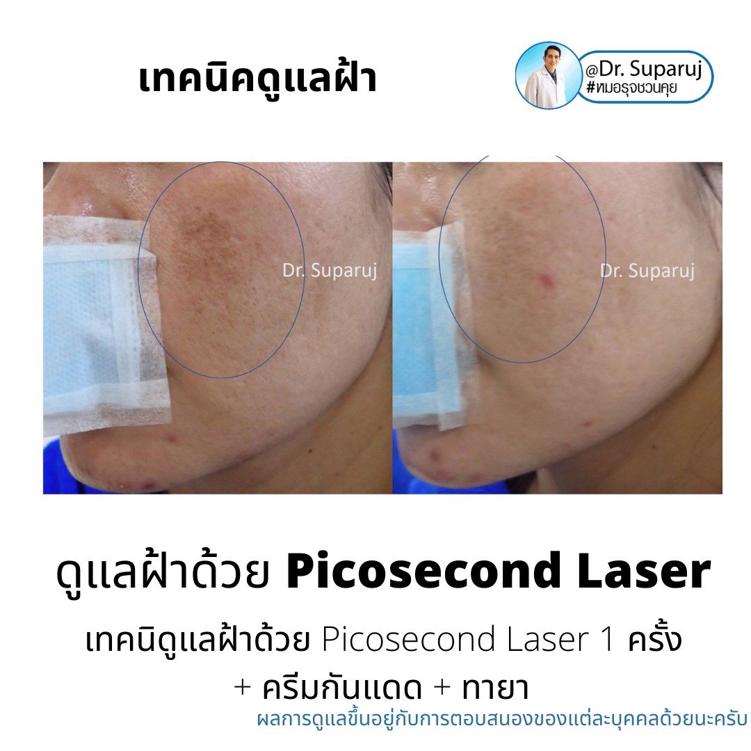 เทคนิคดูแลฝ้าด้วย Picosecond Laser เทคนิคดูแลฝ้าด้วย Picosecond Laser