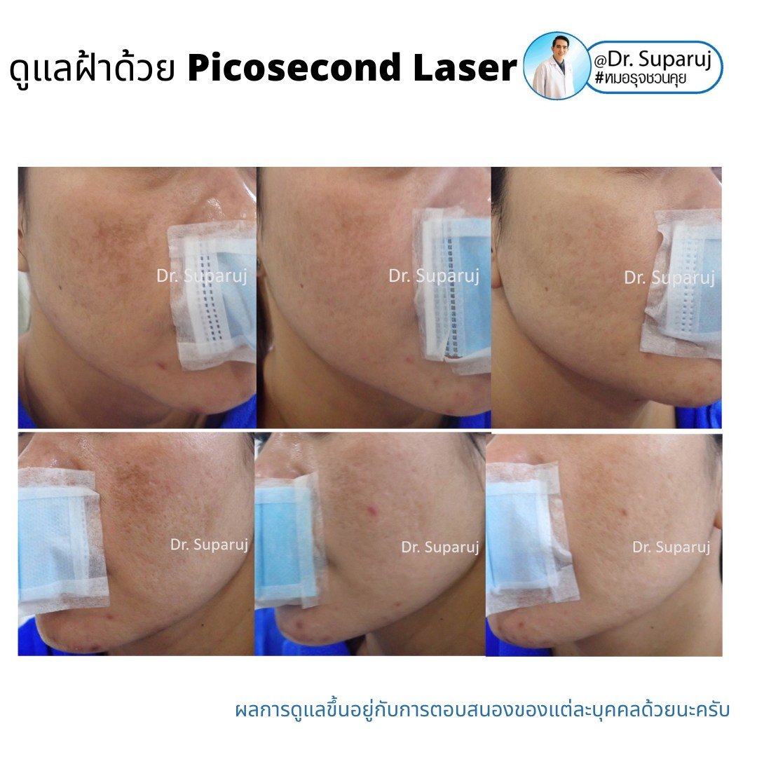 เทคนิคดูแลฝ้าด้วย Picosecond Laser เทคนิคดูแลฝ้าด้วย Picosecond Laser