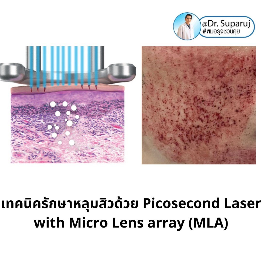 เทคนิครักษาหลุมสิวด้วย Picosecond Laser with Micro Lens array (MLA) มีกลไกล & จุดเด่นอย่างไร? เทคนิครักษาหลุมสิวด้วย Picosecond Laser with Micro Lens array (MLA) มีกลไกล & จุดเด่นอย่างไร?