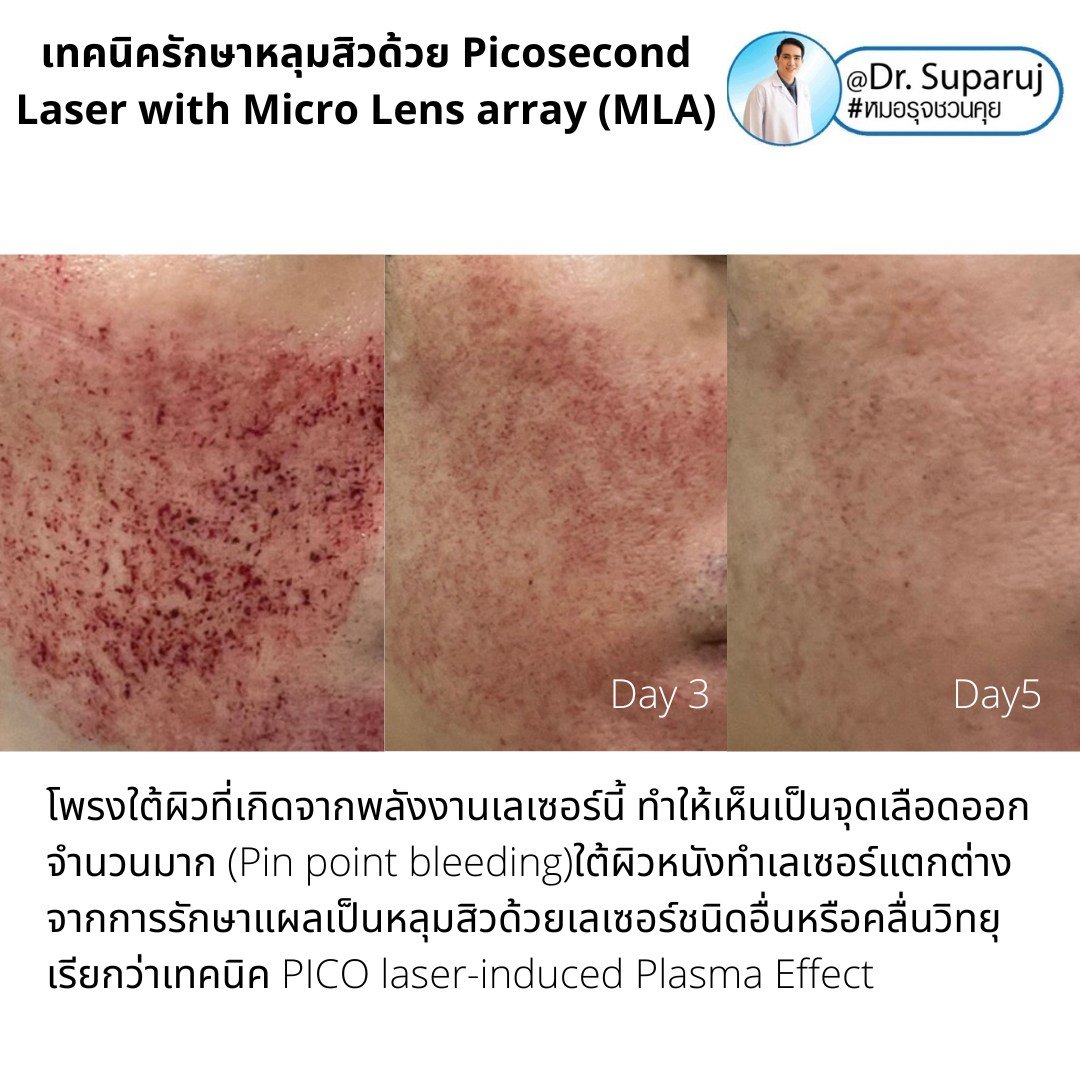 เทคนิครักษาหลุมสิวด้วย Picosecond Laser with Micro Lens array (MLA) มีกลไกล & จุดเด่นอย่างไร? เทคนิครักษาหลุมสิวด้วย Picosecond Laser with Micro Lens array (MLA) มีกลไกล & จุดเด่นอย่างไร?