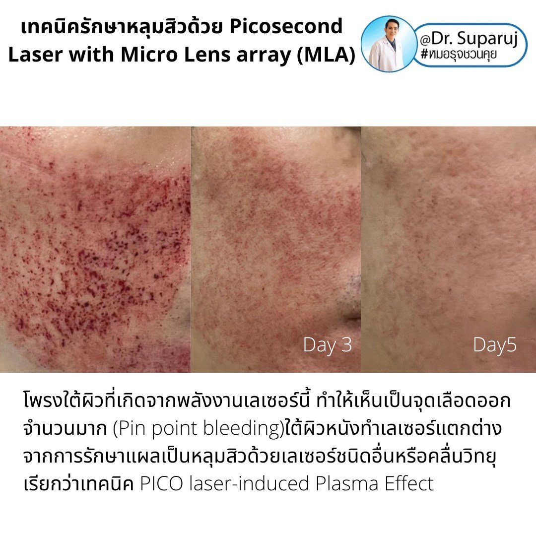 เทคนิครักษาหลุมสิวด้วย Picosecond Laser with Micro Lens array (MLA) มีกลไกล & จุดเด่นอย่างไร?