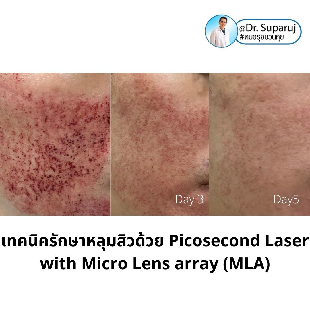 เทคนิครักษาหลุมสิวด้วย Picosecond Laser with Micro Lens array (MLA) มีกลไกล & จุดเด่นอย่างไร? เทคนิครักษาหลุมสิวด้วย Picosecond Laser with Micro Lens array (MLA) มีกลไกล & จุดเด่นอย่างไร?