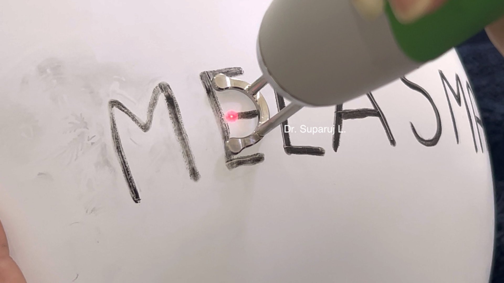 Picosecond Laser เทคโนโลยีพลังงานสูงในช่วงระยะเวลาที่สั้นมากช่วยทำลายเม็ดสีได้อย่างมีประสิทธิภาพ โดยส่งผลต่อเนื้อเยื่อข้างเคียงน้อยมาก Picosecond Laser เทคโนโลยีพลังงานสูงในช่วงระยะเวลาที่สั้นมากช่วยทำลายเม็ดสีได้อย่างมีประสิทธิภาพ โดยส่งผลต่อเนื้อเยื่อข้างเคียงน้อยมาก