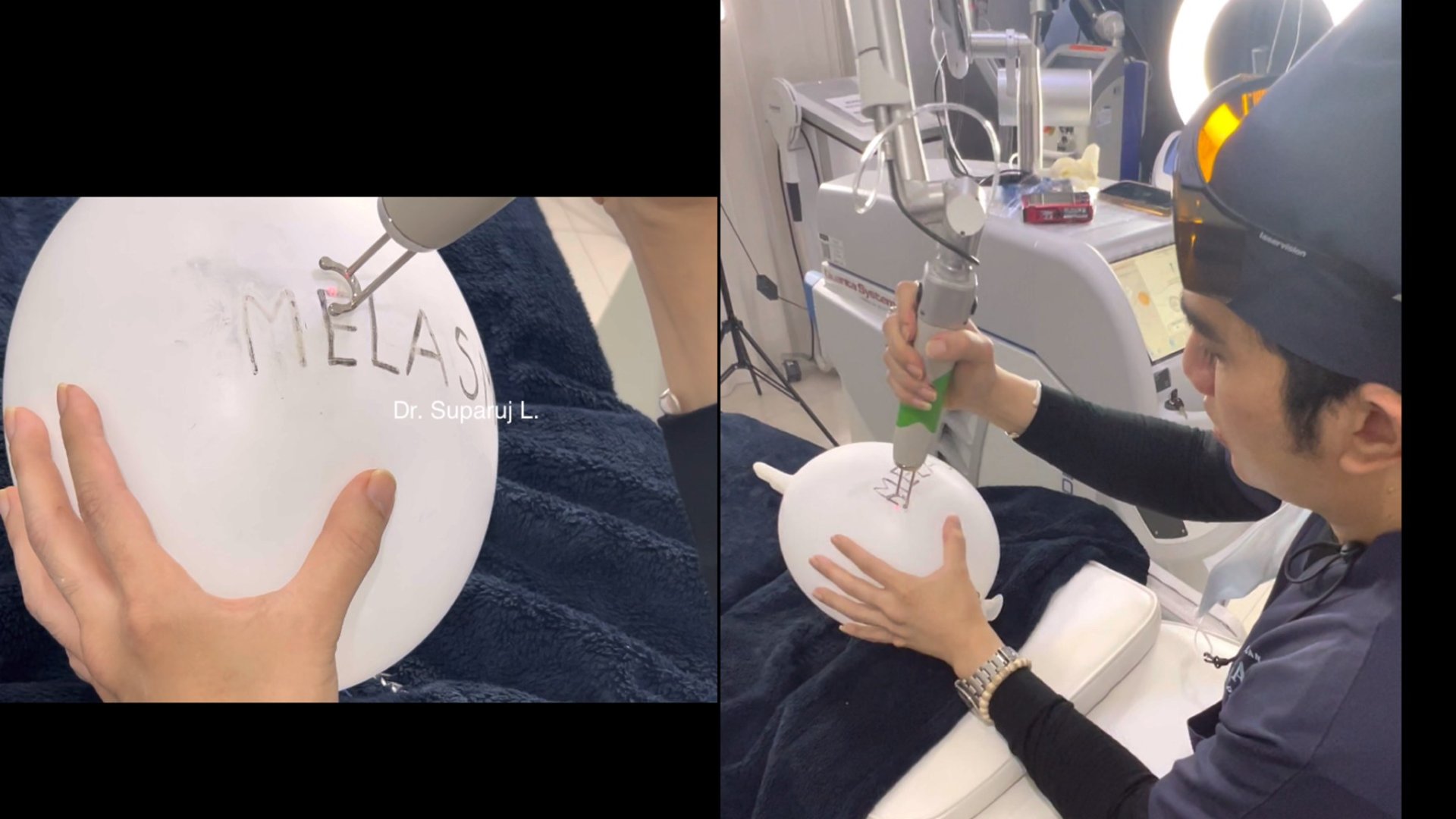 Picosecond Laser เทคโนโลยีพลังงานสูงในช่วงระยะเวลาที่สั้นมากช่วยทำลายเม็ดสีได้อย่างมีประสิทธิภาพ โดยส่งผลต่อเนื้อเยื่อข้างเคียงน้อยมาก Picosecond Laser เทคโนโลยีพลังงานสูงในช่วงระยะเวลาที่สั้นมากช่วยทำลายเม็ดสีได้อย่างมีประสิทธิภาพ โดยส่งผลต่อเนื้อเยื่อข้างเคียงน้อยมาก