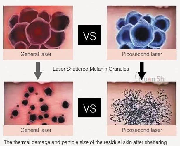 Picosecond Laser เทคโนโลยีพลังงานสูงในช่วงระยะเวลาที่สั้นมากช่วยทำลายเม็ดสีได้อย่างมีประสิทธิภาพ โดยส่งผลต่อเนื้อเยื่อข้างเคียงน้อยมาก