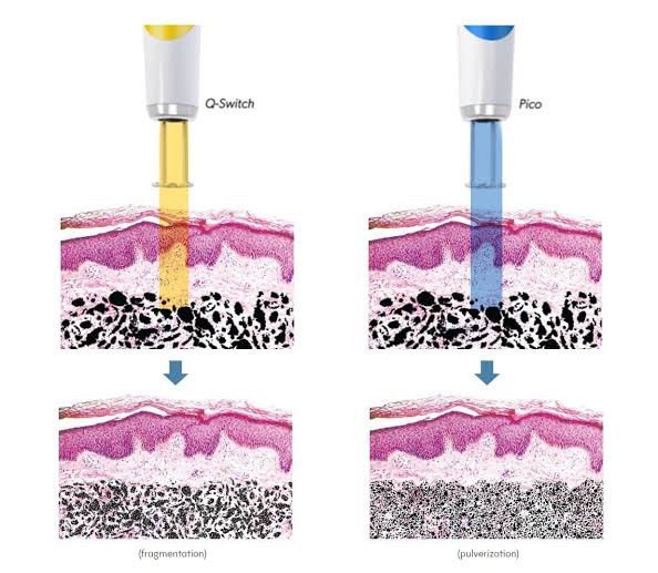 Picosecond Laser เทคโนโลยีพลังงานสูงในช่วงระยะเวลาที่สั้นมากช่วยทำลายเม็ดสีได้อย่างมีประสิทธิภาพ โดยส่งผลต่อเนื้อเยื่อข้างเคียงน้อยมาก Picosecond Laser เทคโนโลยีพลังงานสูงในช่วงระยะเวลาที่สั้นมากช่วยทำลายเม็ดสีได้อย่างมีประสิทธิภาพ โดยส่งผลต่อเนื้อเยื่อข้างเคียงน้อยมาก