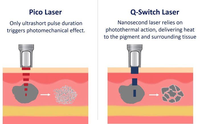 Picosecond Laser เทคโนโลยีพลังงานสูงในช่วงระยะเวลาที่สั้นมากช่วยทำลายเม็ดสีได้อย่างมีประสิทธิภาพ โดยส่งผลต่อเนื้อเยื่อข้างเคียงน้อยมาก Picosecond Laser เทคโนโลยีพลังงานสูงในช่วงระยะเวลาที่สั้นมากช่วยทำลายเม็ดสีได้อย่างมีประสิทธิภาพ โดยส่งผลต่อเนื้อเยื่อข้างเคียงน้อยมาก