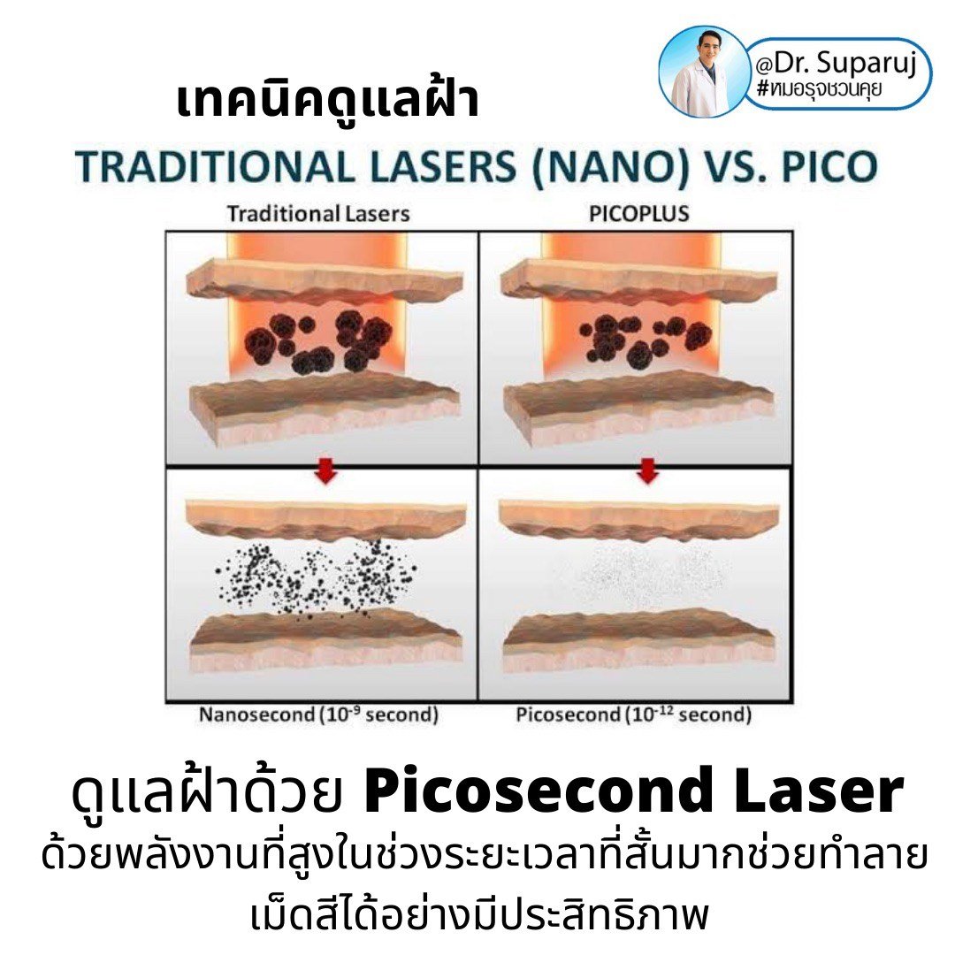 Picosecond Laser เทคโนโลยีพลังงานสูงในช่วงระยะเวลาที่สั้นมากช่วยทำลายเม็ดสีได้อย่างมีประสิทธิภาพ โดยส่งผลต่อเนื้อเยื่อข้างเคียงน้อยมาก Picosecond Laser เทคโนโลยีพลังงานสูงในช่วงระยะเวลาที่สั้นมากช่วยทำลายเม็ดสีได้อย่างมีประสิทธิภาพ โดยส่งผลต่อเนื้อเยื่อข้างเคียงน้อยมาก