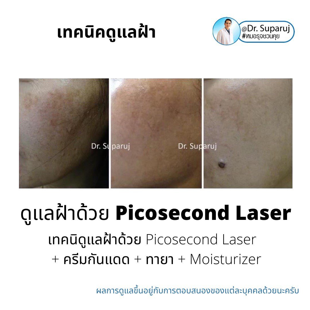 Picosecond Laser เทคโนโลยีพลังงานสูงในช่วงระยะเวลาที่สั้นมากช่วยทำลายเม็ดสีได้อย่างมีประสิทธิภาพ โดยส่งผลต่อเนื้อเยื่อข้างเคียงน้อยมาก Picosecond Laser เทคโนโลยีพลังงานสูงในช่วงระยะเวลาที่สั้นมากช่วยทำลายเม็ดสีได้อย่างมีประสิทธิภาพ โดยส่งผลต่อเนื้อเยื่อข้างเคียงน้อยมาก