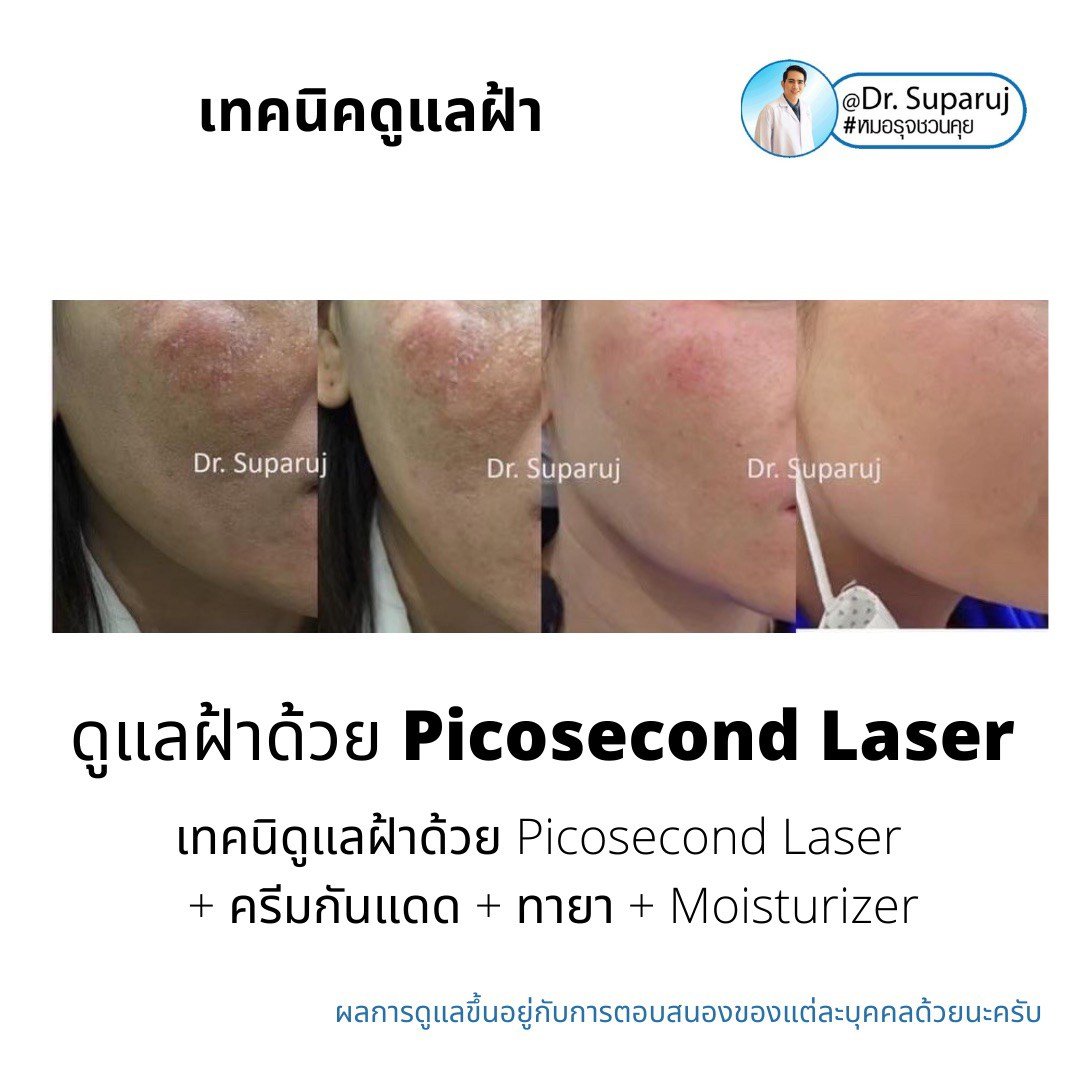 Picosecond Laser เทคโนโลยีพลังงานสูงในช่วงระยะเวลาที่สั้นมากช่วยทำลายเม็ดสีได้อย่างมีประสิทธิภาพ โดยส่งผลต่อเนื้อเยื่อข้างเคียงน้อยมาก Picosecond Laser เทคโนโลยีพลังงานสูงในช่วงระยะเวลาที่สั้นมากช่วยทำลายเม็ดสีได้อย่างมีประสิทธิภาพ โดยส่งผลต่อเนื้อเยื่อข้างเคียงน้อยมาก