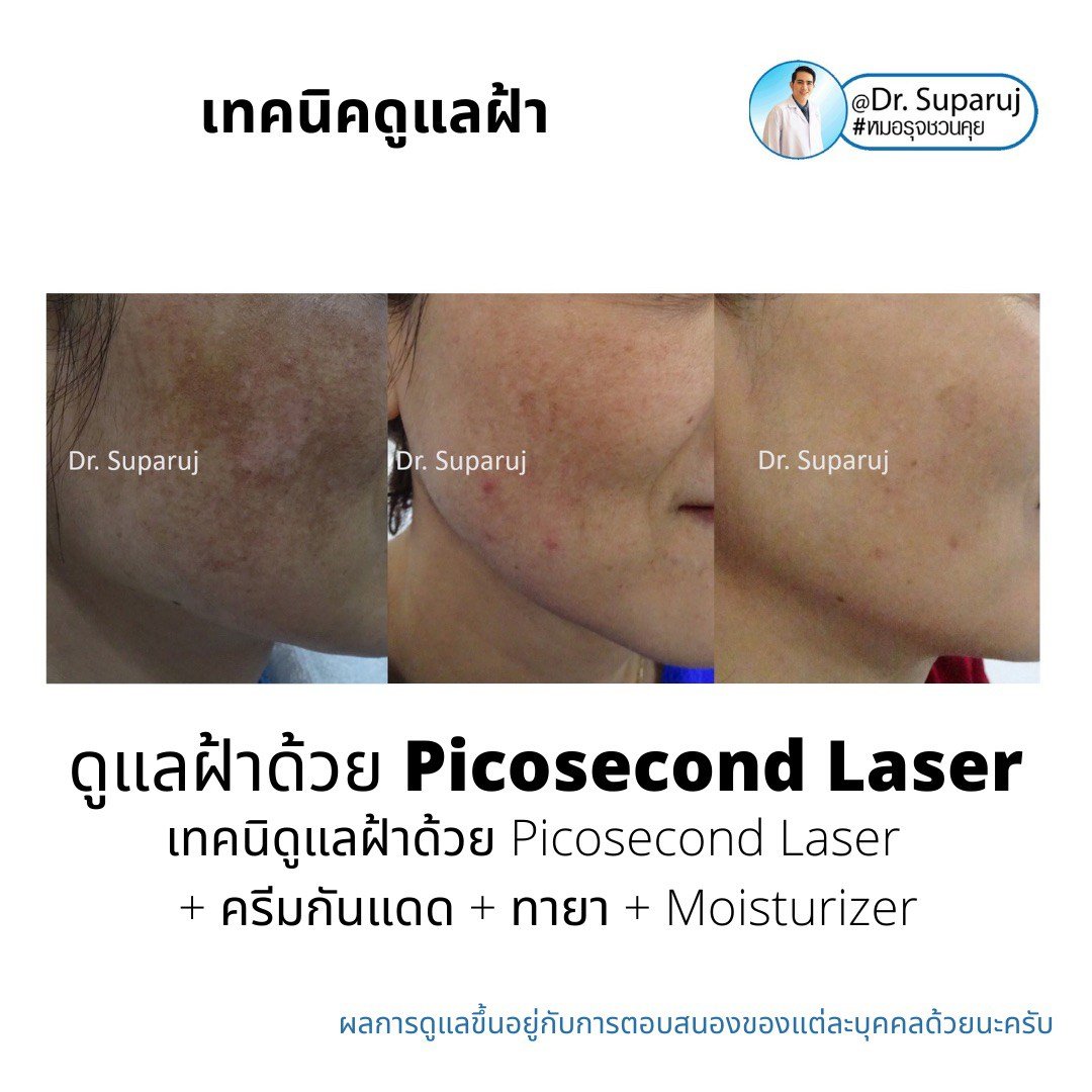 Picosecond Laser เทคโนโลยีพลังงานสูงในช่วงระยะเวลาที่สั้นมากช่วยทำลายเม็ดสีได้อย่างมีประสิทธิภาพ โดยส่งผลต่อเนื้อเยื่อข้างเคียงน้อยมาก