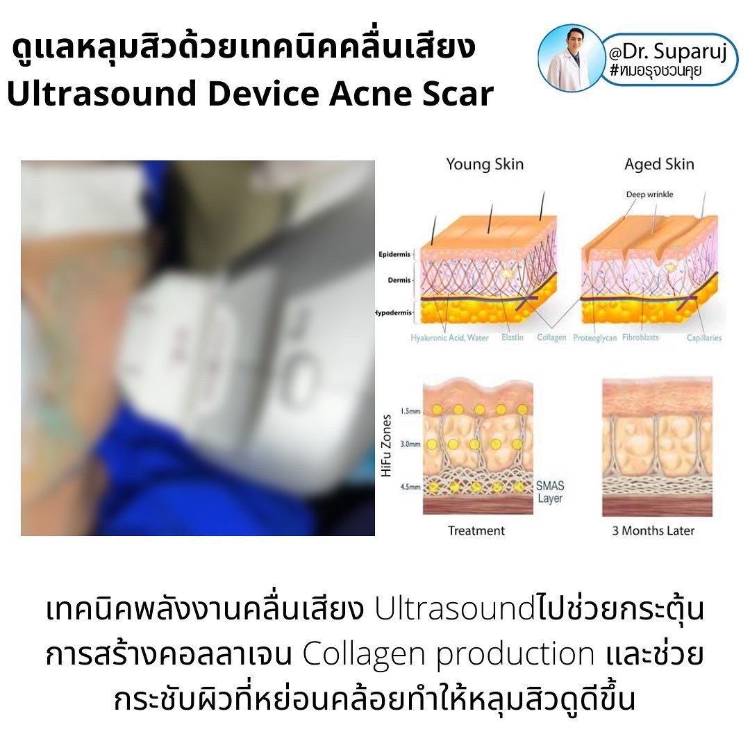 Ultraformer III เทคโนโลยียกกระชับ ลดริ้วรอย ผิวกระชับขึ้น โดยไม่ต้องผ่าตัด Ultraformer III เทคโนโลยียกกระชับ ลดริ้วรอย ผิวกระชับขึ้น โดยไม่ต้องผ่าตัด