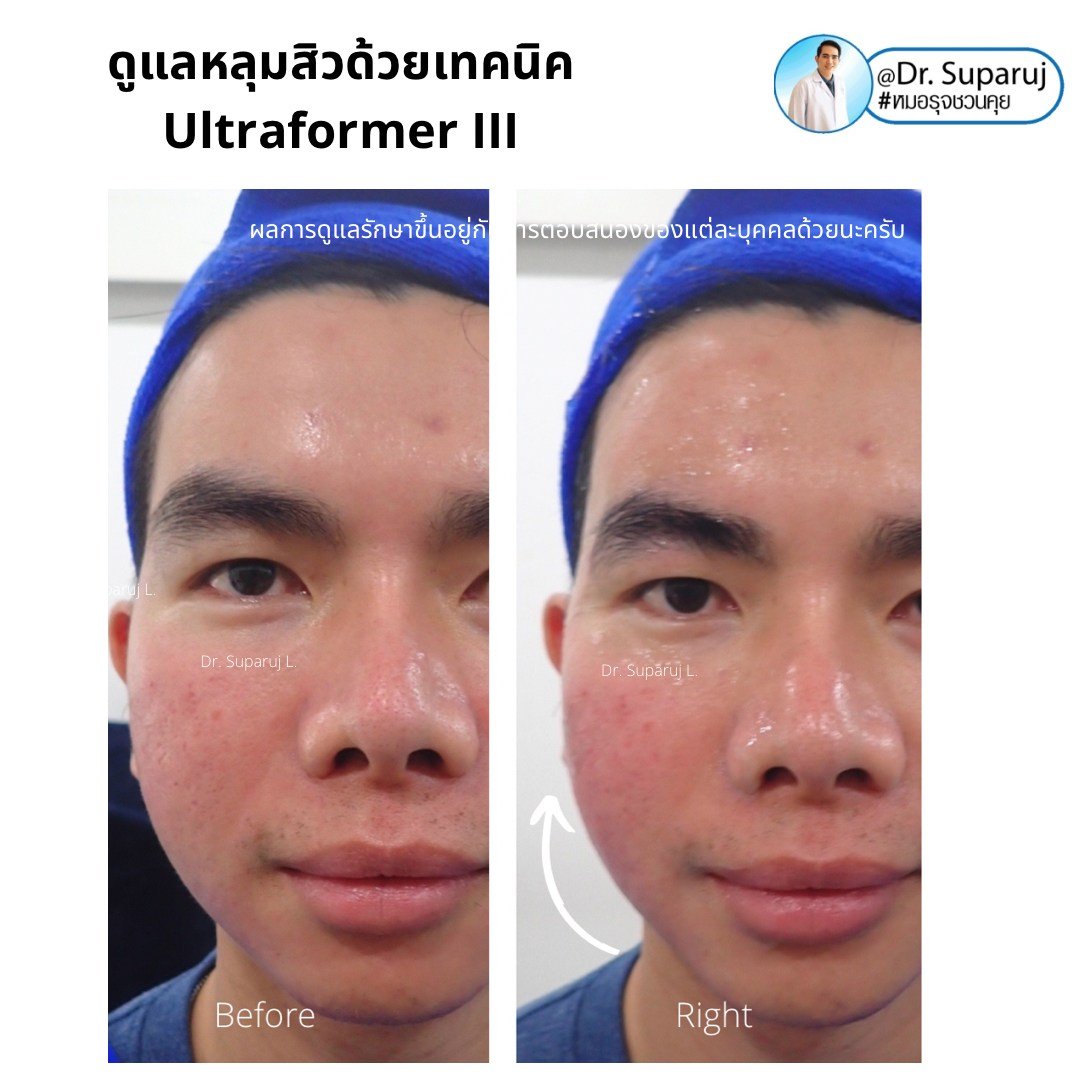 Ultraformer III เทคโนโลยียกกระชับ ลดริ้วรอย ผิวกระชับขึ้น โดยไม่ต้องผ่าตัด Ultraformer III เทคโนโลยียกกระชับ ลดริ้วรอย ผิวกระชับขึ้น โดยไม่ต้องผ่าตัด