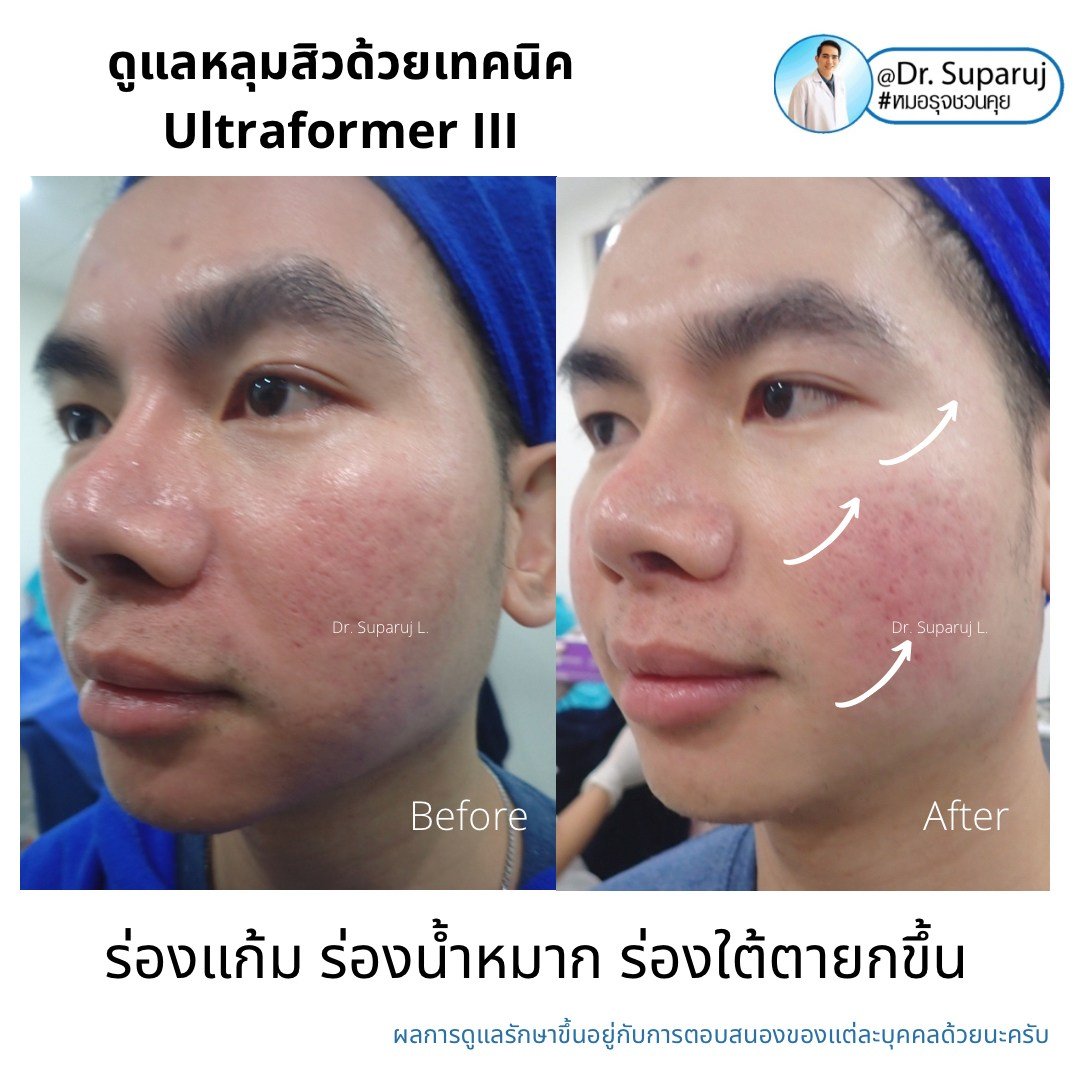 เทคนิคดูแลหลุมสิวด้วยพลังงานคลื่นเสียง Ultraformer III HIFU (Ultrasound-Based Energy Device to Treat Acne Scar)  เทคนิคดูแลหลุมสิวด้วยพลังงานคลื่นเสียง Ultraformer III HIFU (Ultrasound-Based Energy Device to Treat Acne Scar)