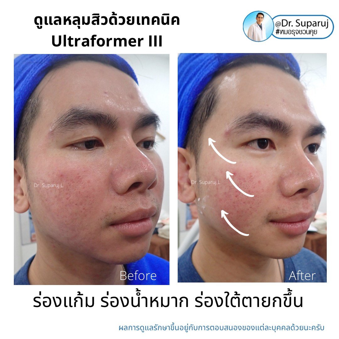 เทคนิคดูแลหลุมสิวด้วยพลังงานคลื่นเสียง Ultraformer III HIFU (Ultrasound-Based Energy Device to Treat Acne Scar) 