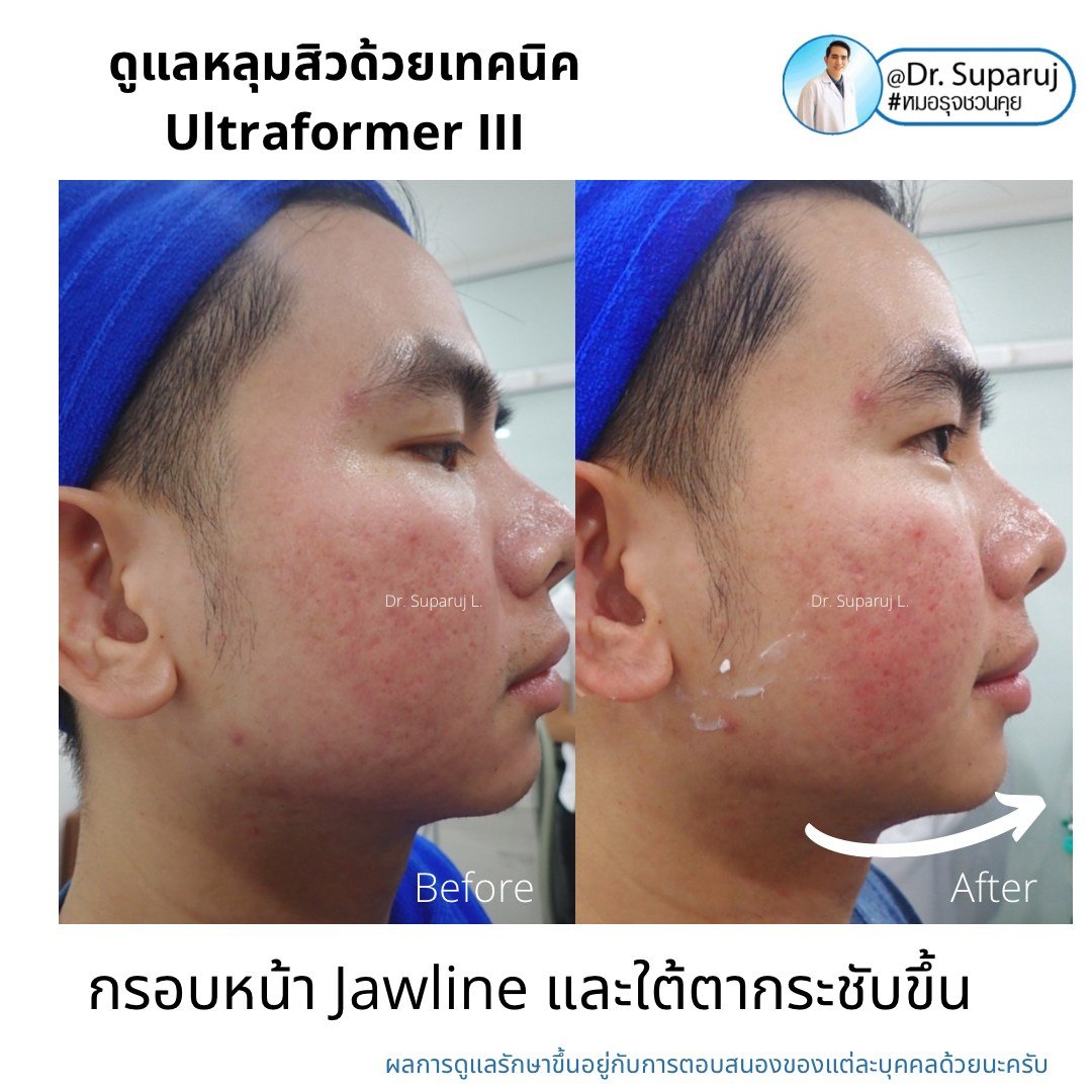 เทคนิคดูแลหลุมสิวด้วยพลังงานคลื่นเสียง Ultraformer III HIFU (Ultrasound-Based Energy Device to Treat Acne Scar) 