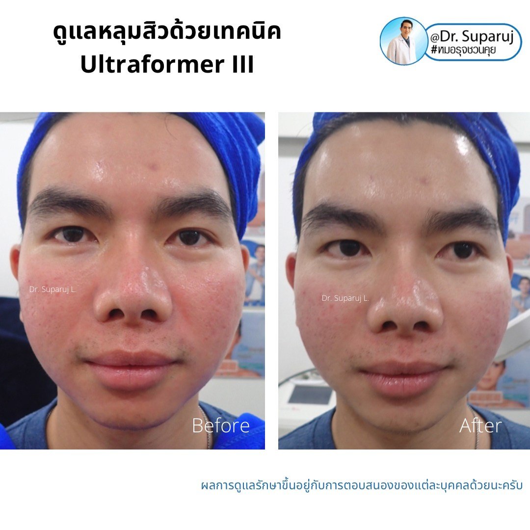 เทคนิคดูแลหลุมสิวด้วยพลังงานคลื่นเสียง Ultraformer III HIFU (Ultrasound-Based Energy Device to Treat Acne Scar)  เทคนิคดูแลหลุมสิวด้วยพลังงานคลื่นเสียง Ultraformer III HIFU (Ultrasound-Based Energy Device to Treat Acne Scar)