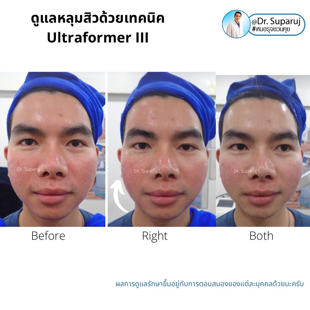 เทคนิคดูแลหลุมสิวด้วยพลังงานคลื่นเสียง Ultraformer III HIFU (Ultrasound-Based Energy Device to Treat Acne Scar)  เทคนิคดูแลหลุมสิวด้วยพลังงานคลื่นเสียง Ultraformer III HIFU (Ultrasound-Based Energy Device to Treat Acne Scar)