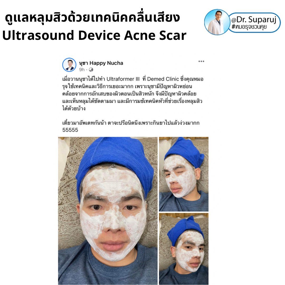 เทคนิคดูแลหลุมสิวด้วยพลังงานคลื่นเสียง Ultraformer III HIFU (Ultrasound-Based Energy Device to Treat Acne Scar)  เทคนิคดูแลหลุมสิวด้วยพลังงานคลื่นเสียง Ultraformer III HIFU (Ultrasound-Based Energy Device to Treat Acne Scar)