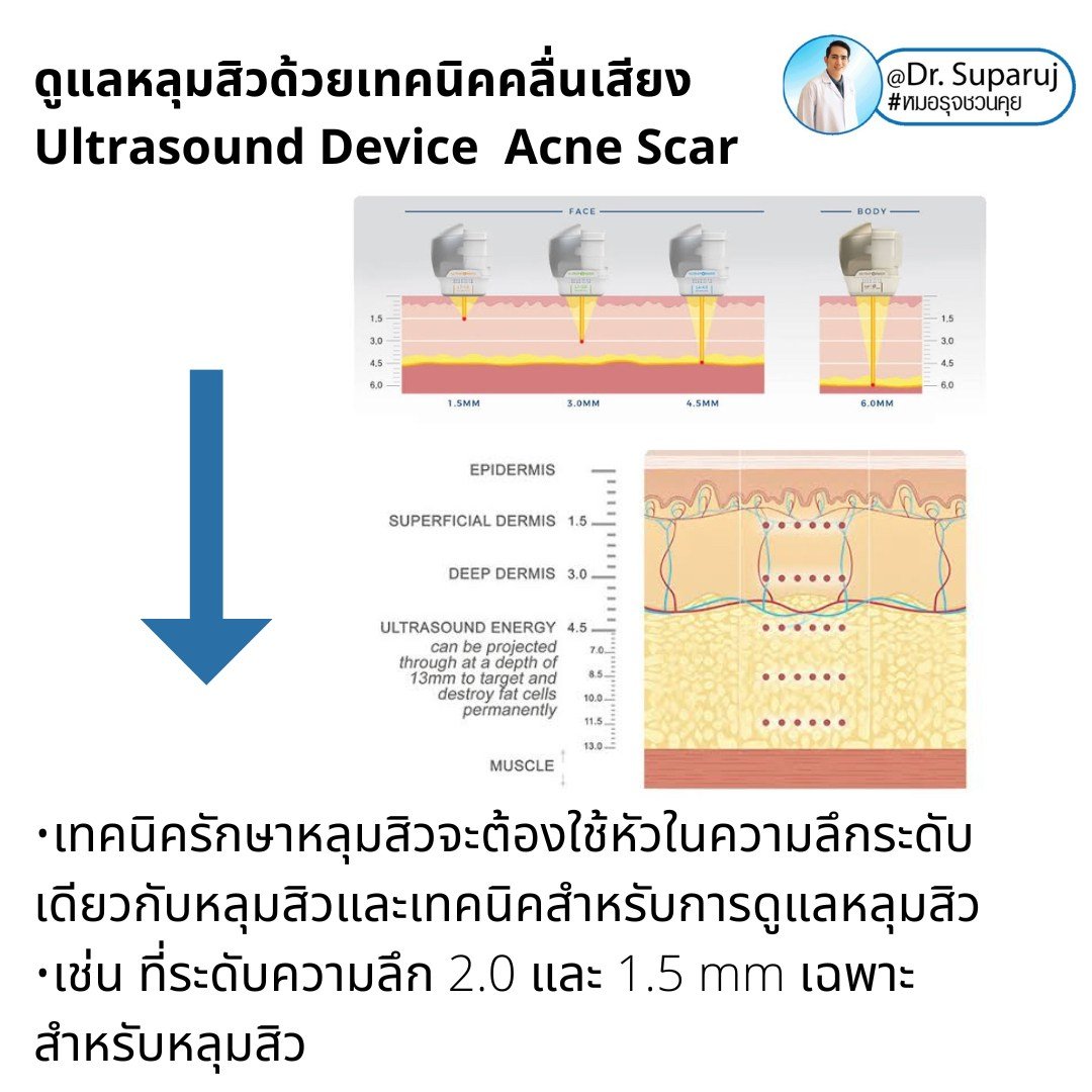 เทคนิคดูแลหลุมสิวด้วยพลังงานคลื่นเสียง Ultraformer III HIFU (Ultrasound-Based Energy Device to Treat Acne Scar)  เทคนิคดูแลหลุมสิวด้วยพลังงานคลื่นเสียง Ultraformer III HIFU (Ultrasound-Based Energy Device to Treat Acne Scar)