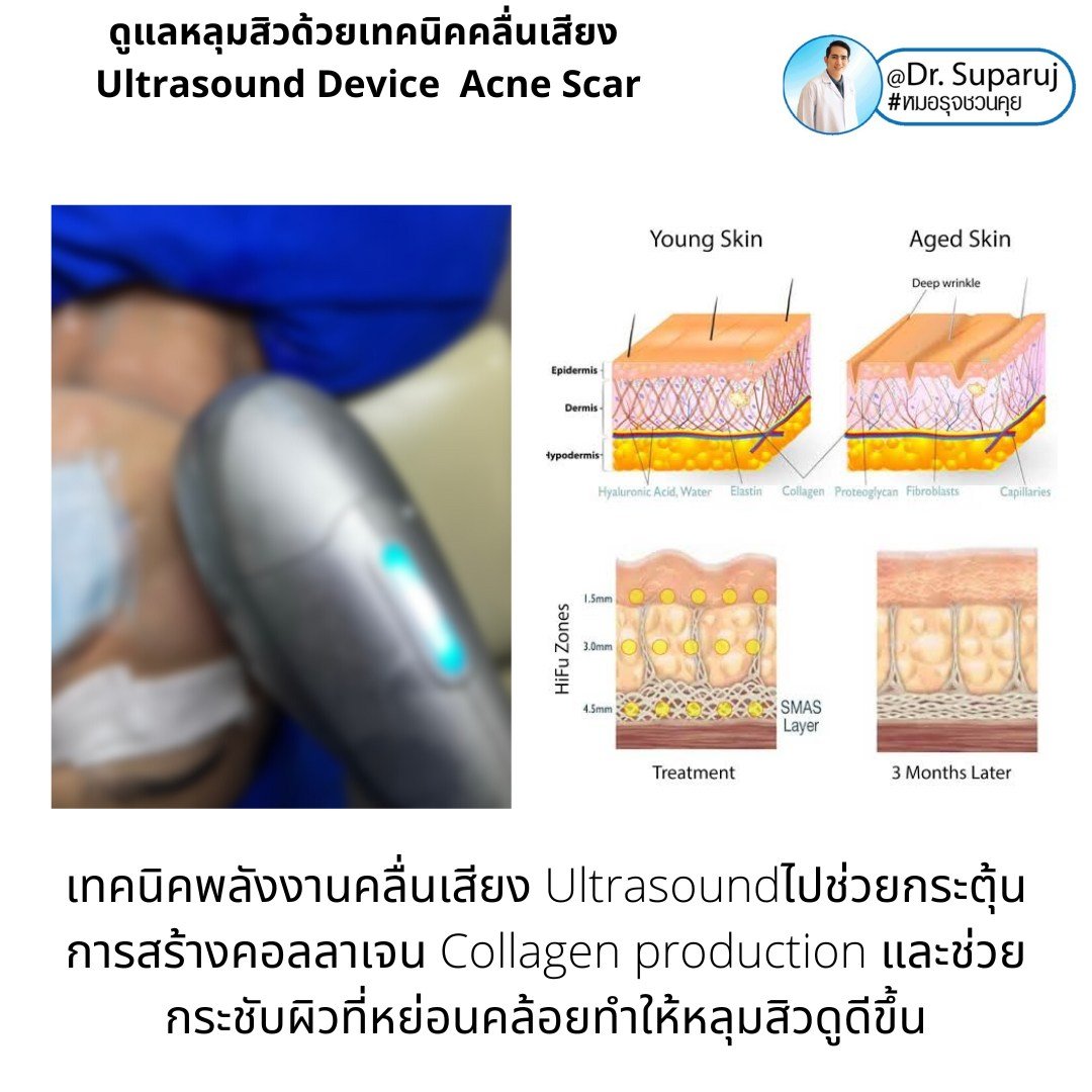 เทคนิคดูแลหลุมสิวด้วยพลังงานคลื่นเสียง Ultraformer III HIFU (Ultrasound-Based Energy Device to Treat Acne Scar) 