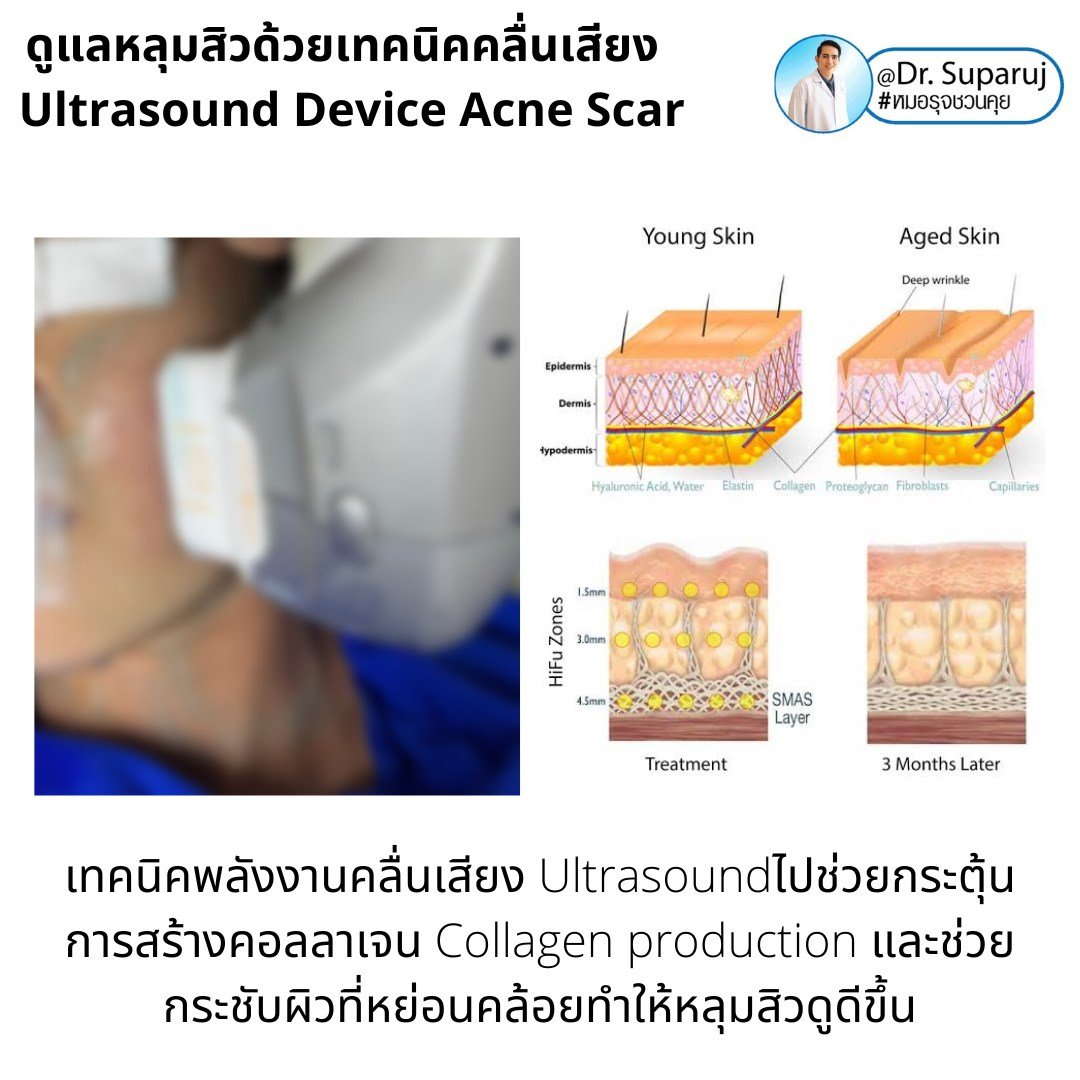 เทคนิคดูแลหลุมสิวด้วยพลังงานคลื่นเสียง Ultraformer III HIFU (Ultrasound-Based Energy Device to Treat Acne Scar)  เทคนิคดูแลหลุมสิวด้วยพลังงานคลื่นเสียง Ultraformer III HIFU (Ultrasound-Based Energy Device to Treat Acne Scar)