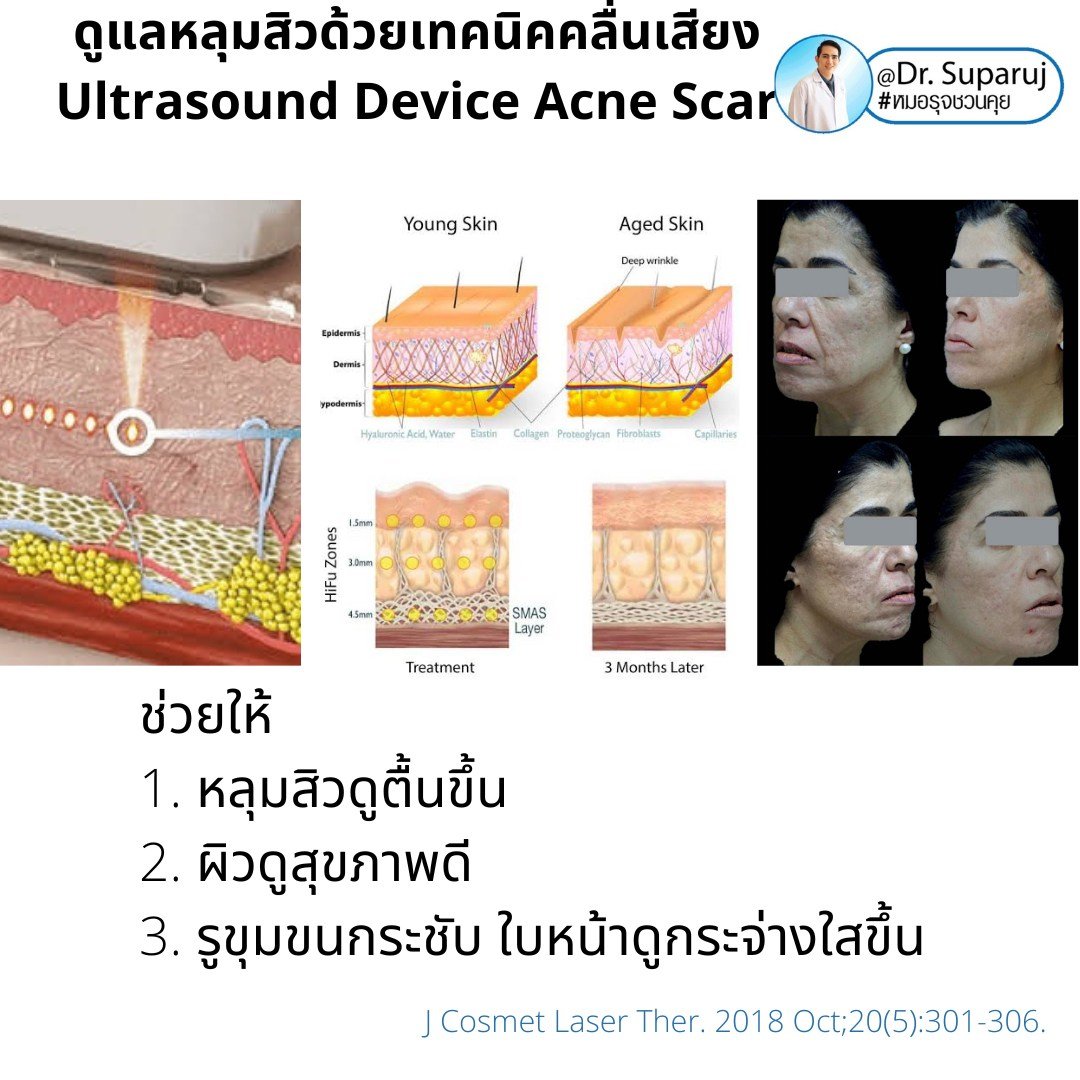 เทคนิคดูแลหลุมสิวด้วยพลังงานคลื่นเสียง Ultraformer III HIFU (Ultrasound-Based Energy Device to Treat Acne Scar)  เทคนิคดูแลหลุมสิวด้วยพลังงานคลื่นเสียง Ultraformer III HIFU (Ultrasound-Based Energy Device to Treat Acne Scar)