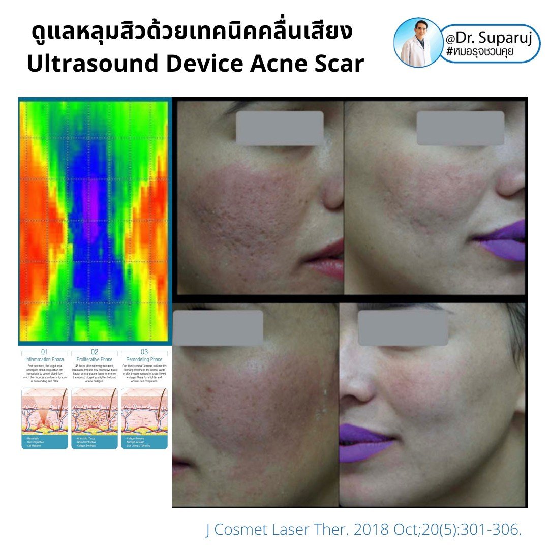เทคนิคดูแลหลุมสิวด้วยพลังงานคลื่นเสียง Ultraformer III HIFU (Ultrasound-Based Energy Device to Treat Acne Scar)  เทคนิคดูแลหลุมสิวด้วยพลังงานคลื่นเสียง Ultraformer III HIFU (Ultrasound-Based Energy Device to Treat Acne Scar)