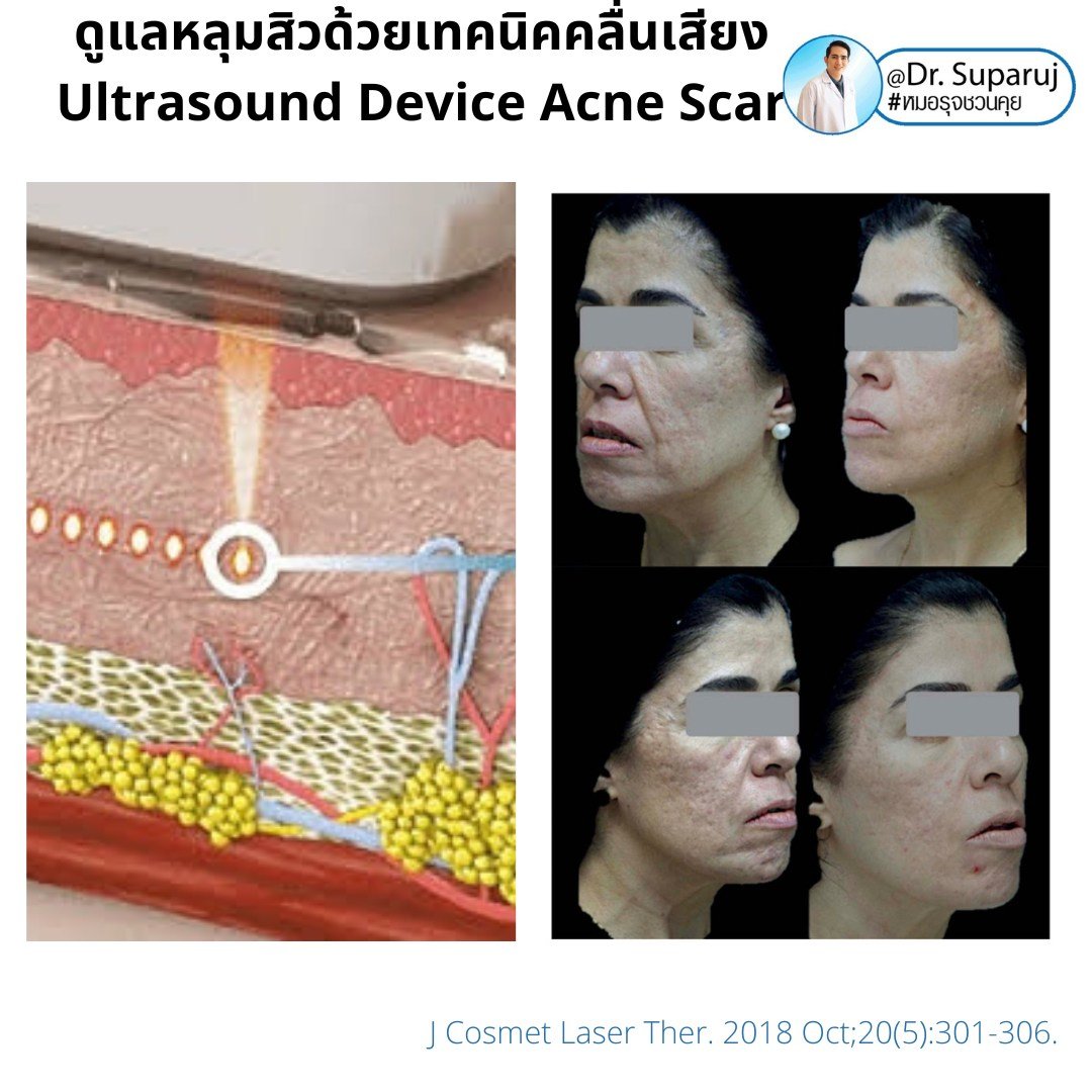 เทคนิคดูแลหลุมสิวด้วยพลังงานคลื่นเสียง Ultraformer III HIFU (Ultrasound-Based Energy Device to Treat Acne Scar)  เทคนิคดูแลหลุมสิวด้วยพลังงานคลื่นเสียง Ultraformer III HIFU (Ultrasound-Based Energy Device to Treat Acne Scar)