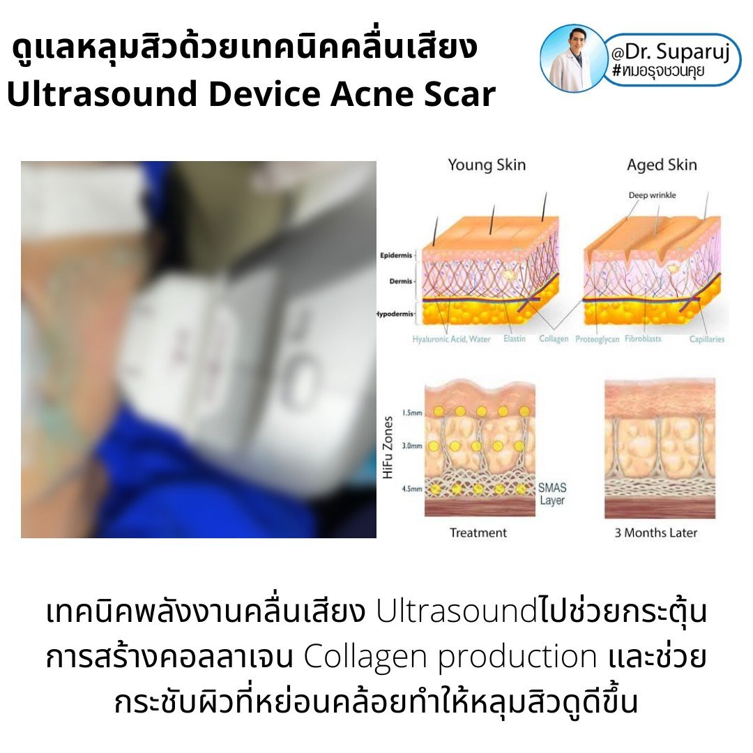 เทคนิคดูแลหลุมสิวด้วยพลังงานคลื่นเสียง Ultraformer III HIFU (Ultrasound-Based Energy Device to Treat Acne Scar) 