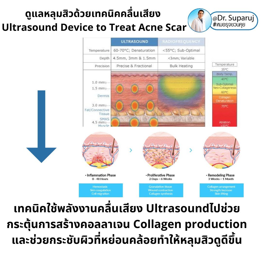 เทคนิคดูแลหลุมสิวด้วยพลังงานคลื่นเสียง Ultraformer III HIFU (Ultrasound-Based Energy Device to Treat Acne Scar)  เทคนิคดูแลหลุมสิวด้วยพลังงานคลื่นเสียง Ultraformer III HIFU (Ultrasound-Based Energy Device to Treat Acne Scar)