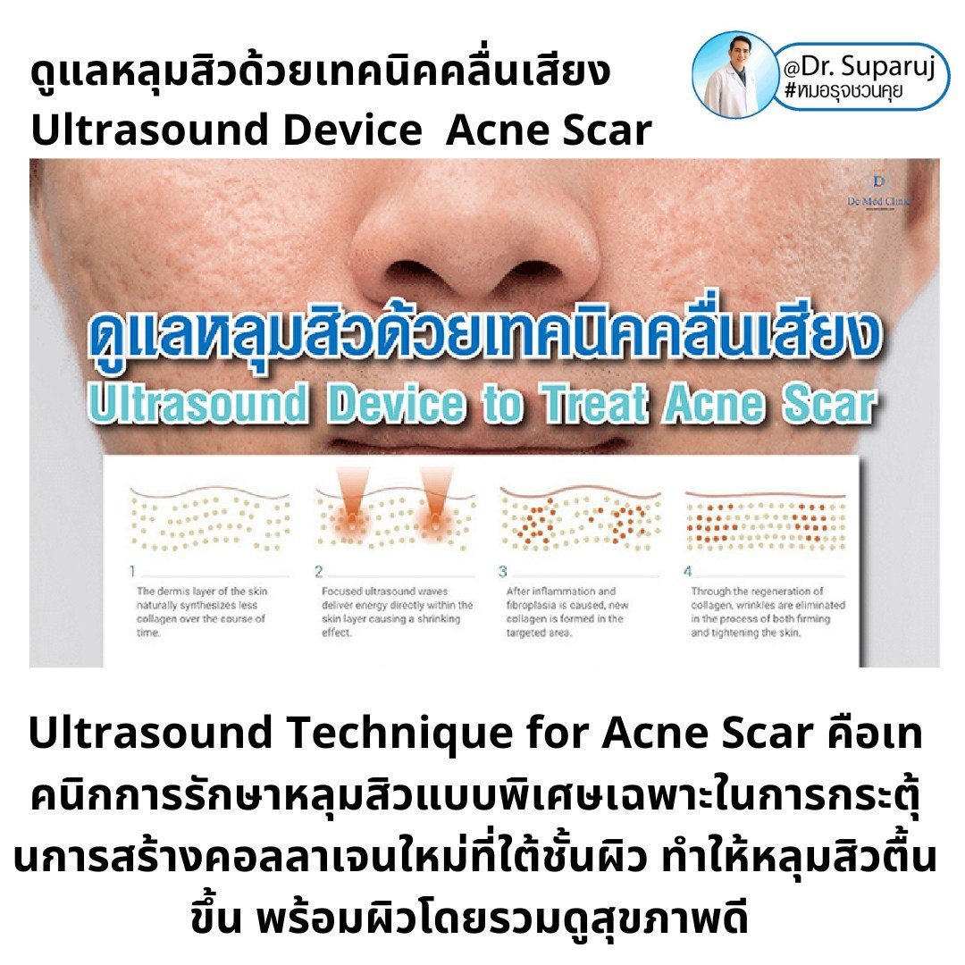 เทคนิคดูแลหลุมสิวด้วยพลังงานคลื่นเสียง Ultraformer III HIFU (Ultrasound-Based Energy Device to Treat Acne Scar)  เทคนิคดูแลหลุมสิวด้วยพลังงานคลื่นเสียง Ultraformer III HIFU (Ultrasound-Based Energy Device to Treat Acne Scar)