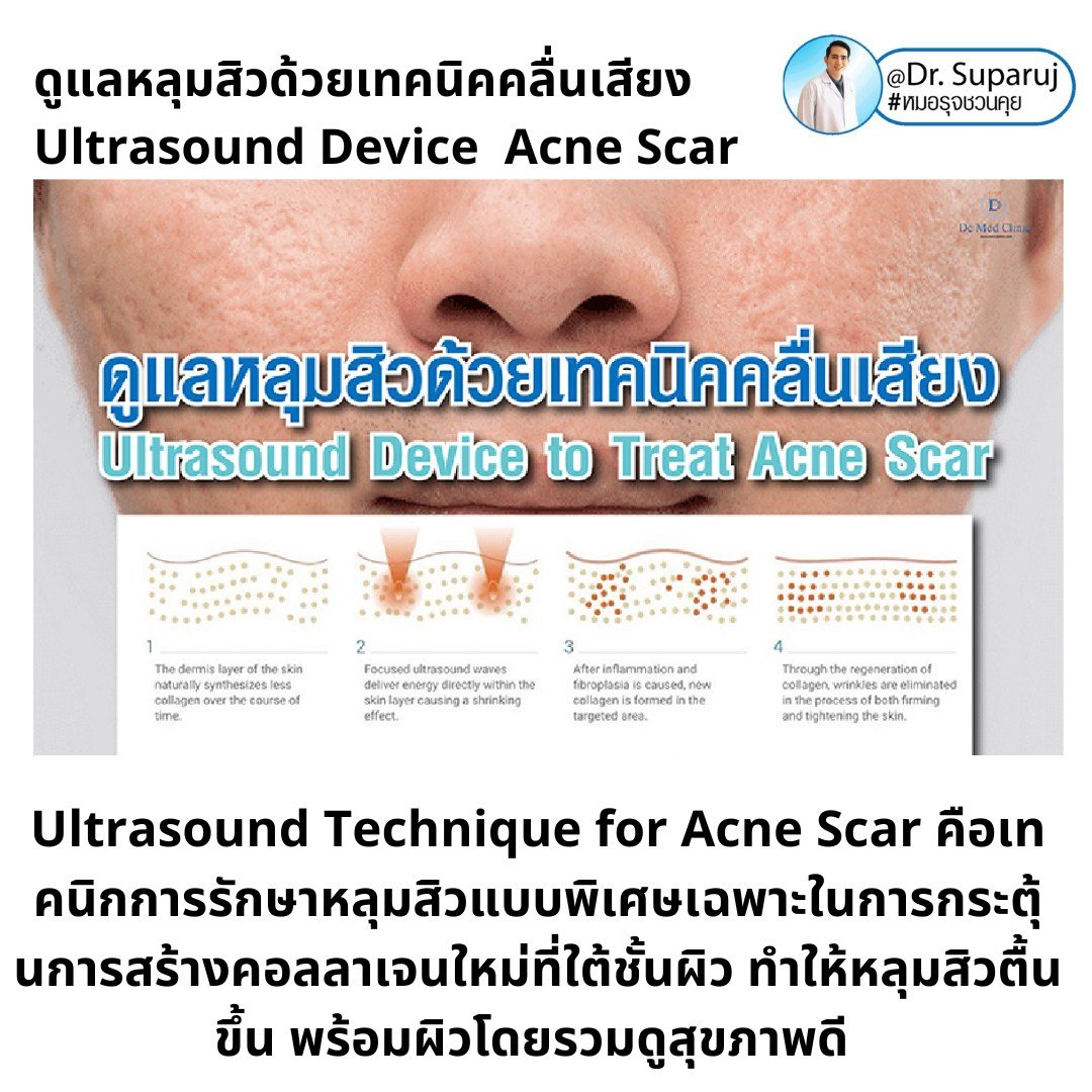 เทคนิคดูแลหลุมสิวด้วยพลังงานคลื่นเสียง Ultraformer III HIFU (Ultrasound-Based Energy Device to Treat Acne Scar) 